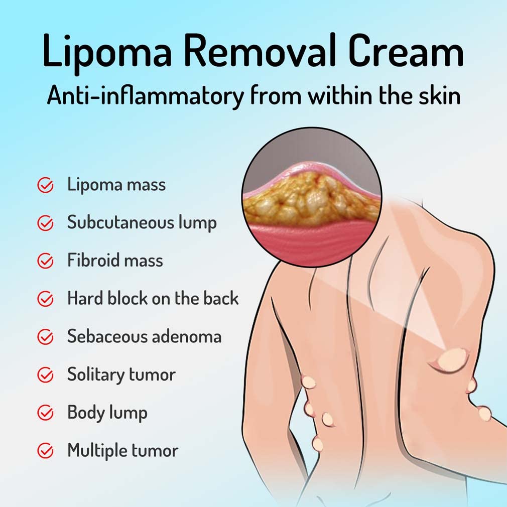 Lipoma Removal Cream, Mild, Easy to Use,