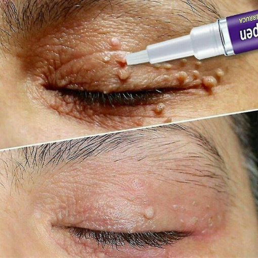 12 Hours Wart Remover Pen Skin Tag Mole Remover Elite Foot Warts Unis