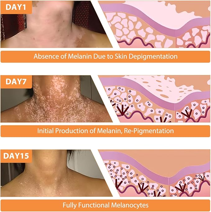 Vitiligo Bee Venom Treatment Cream, Skin Topical Cream,