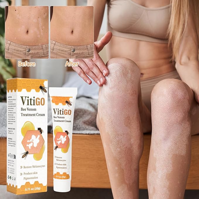 Vitiligo Bee Venom Treatment Cream, Skin Topical Cream,